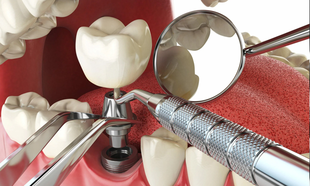 Dental Implants